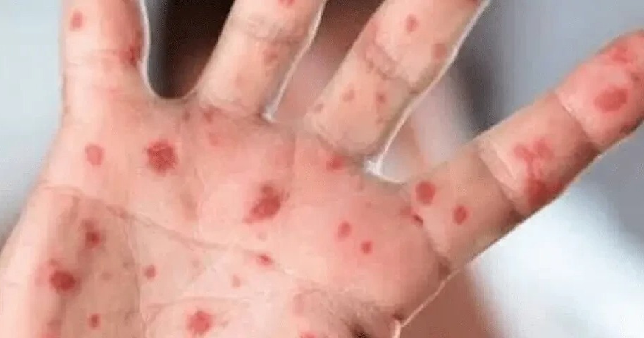 کراچی آئے مسافر میں منکی پاکس کی علامات کا شبہ