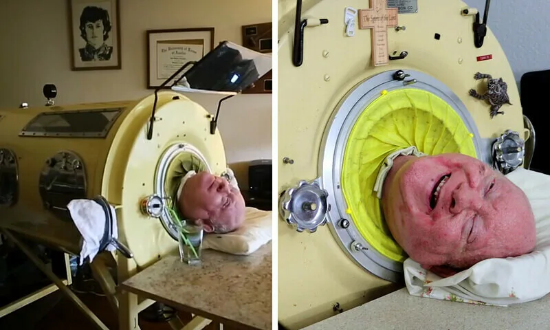 70 سال سےزائد عرصے تک مصنوعی سانس کی مشین پر زندہ رہنےوالا  مفلوج شخص چل بسا