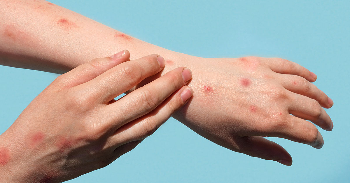 پاکستان میں منکی پاکس کا ایک اور کیس سامنے آ گیا