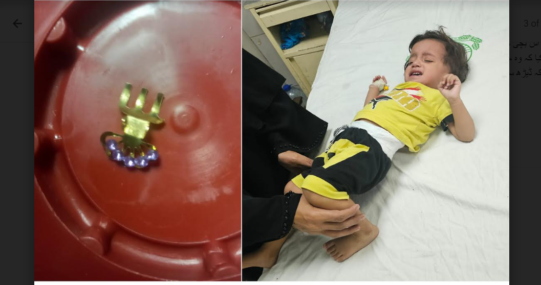 ڈاکٹرز نے بغیر آپریشن ڈیڑھ سالہ بچی کے معدے سے ہئیر کلپ نکال لیا
