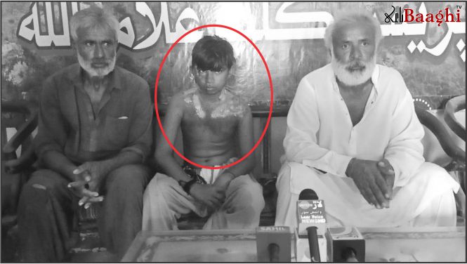 غلام اللہ: 13 سالہ مزدور بچے پربہیمانہ تشدد،گرم چائے انڈیل دی، 40 فیصد جسم جھلس گیا