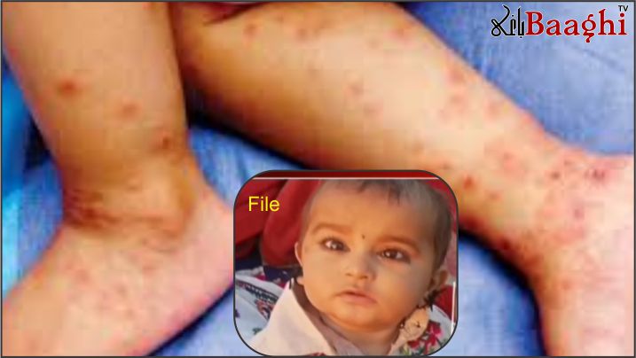 تنگوانی: خسرہ کی وباء بے قابو، ہلاکتوں کی تعداد 8 ہو گئی