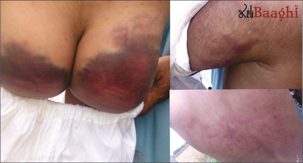 پنڈی گھیب:ظلم کی انتہا،استاد کاطالب علم پر بہیمانہ تشدد،بےہوشی کی حالت میں چوڑکرچلاگیا